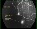 DREPANOCYTOSE - Dr Gérard ROYER