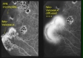 DREPANOCYTOSE - Dr Gérard ROYER