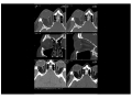 Cas clinique en ophtalmologie - Dr.Mnasri / CH Meaux (COHF 2014)