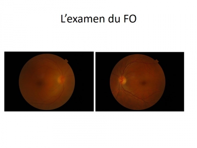 Cas clinique en ophtalmologie - Dr.Mnasri / CH Meaux (COHF 2014)